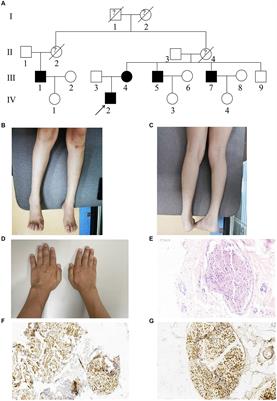 Clinical, neurophysiological evaluation and genetic features of axonal Charcot–Marie–Tooth disease in a Chinese family
